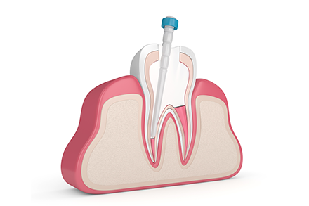 重度の虫歯は根管治療