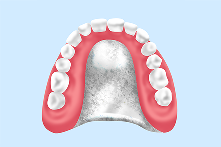 金属床義歯
