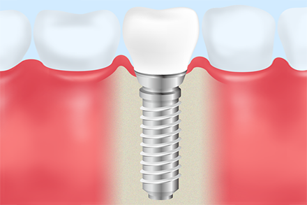 常に最適なインプラント治療をご提案します