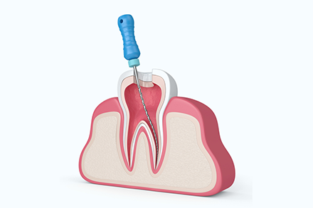 根管治療とは